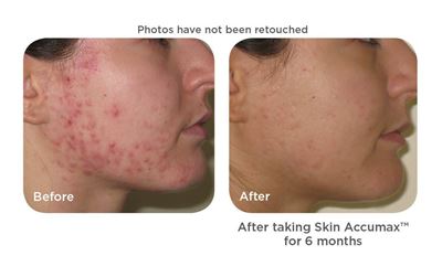 Skin Accumax (180 capsules) image 1
